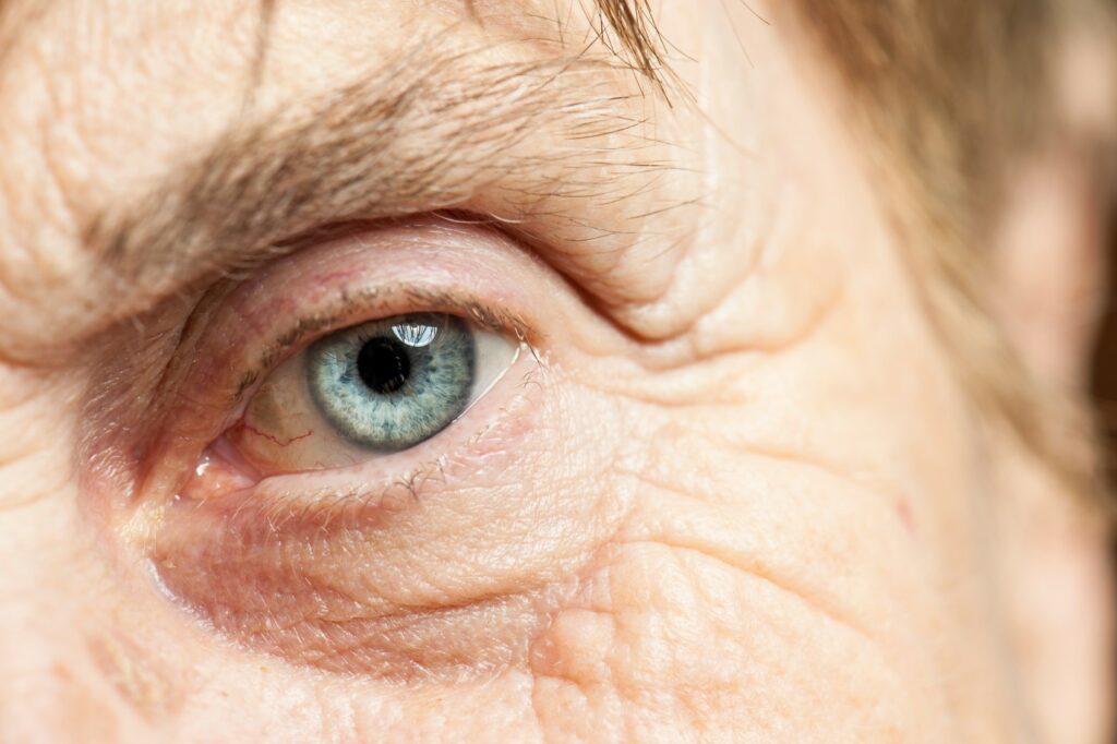 5 Symptoms of Cataracts