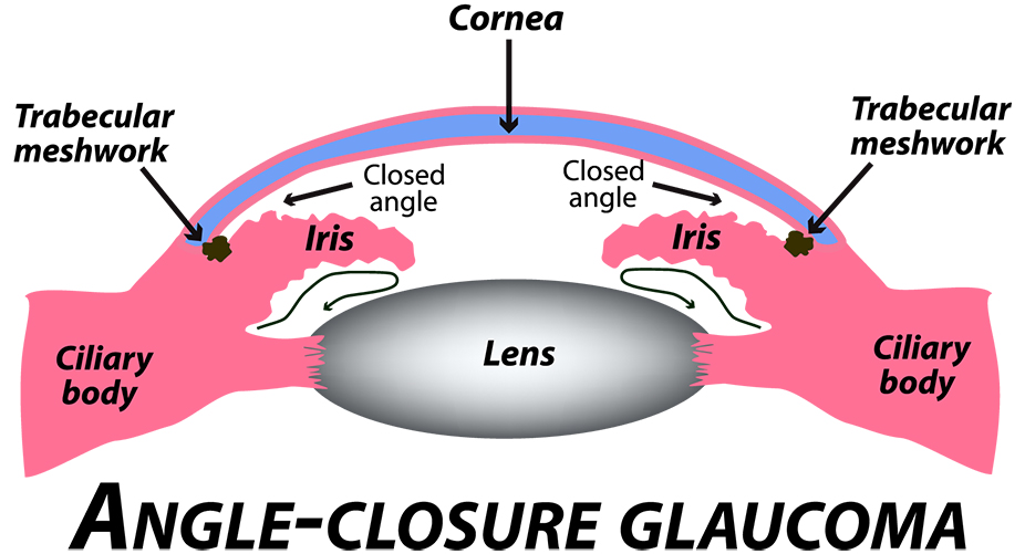 Closed Angle Glaucoma illustration
