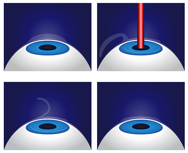 Excimer Laser illustration