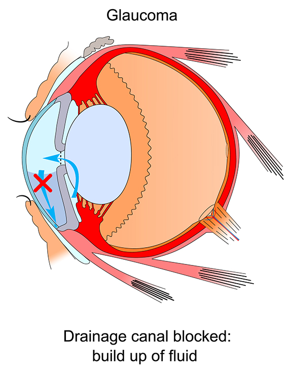 Glaucoma fluid build up illustration