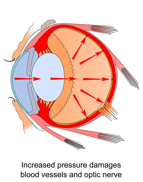 Glaucoma pressure and damaged optic nerve illustration