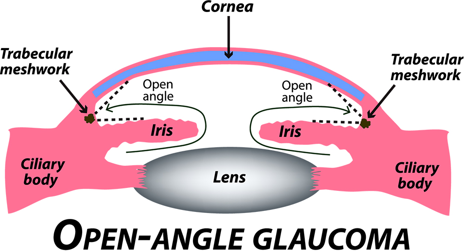 Open Angle Glaucoma illustration