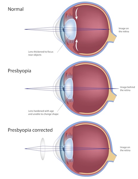 Presbyopia diagram